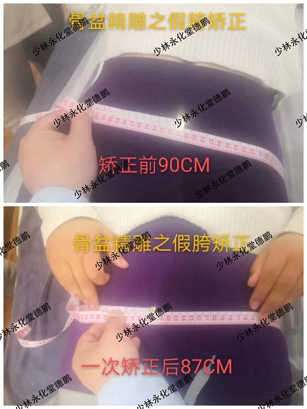 少林永化堂產(chǎn)后項目-骨盆修復1.jpg